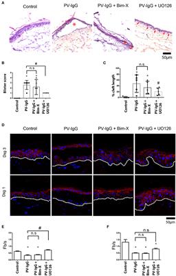 Role of PKC and ERK Signaling in Epidermal Blistering and Desmosome Regulation in Pemphigus